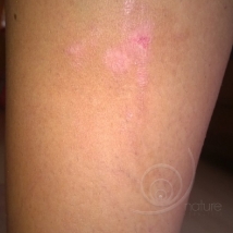 After burn wound caused by Heracleum Sosnowskyi... (calf) - by clicking on the picture you will open the gallery