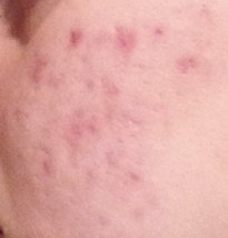 Atrophic scars (acne scars) - by clicking on the picture you will open the gallery