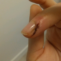 3. Skin damage after finger treatment third day of application