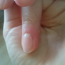 Skin damage after finger treatment