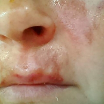 Skin damage on the face caused by hot water scalding
