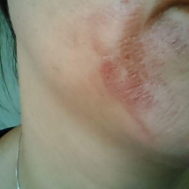 Skin damage on the face caused by hot water scalding