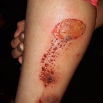 1. Skin damage on the legs caused by motorcycle exhaust pipe burns - 11.07.2017