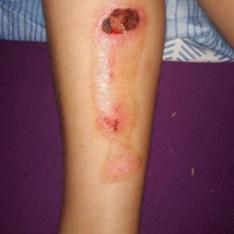 Skin damage on the legs caused by motorcycle exhaust pipe burns