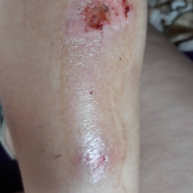 3. Skin damage on the legs caused by motorcycle exhaust pipe burns - 21.07.2018